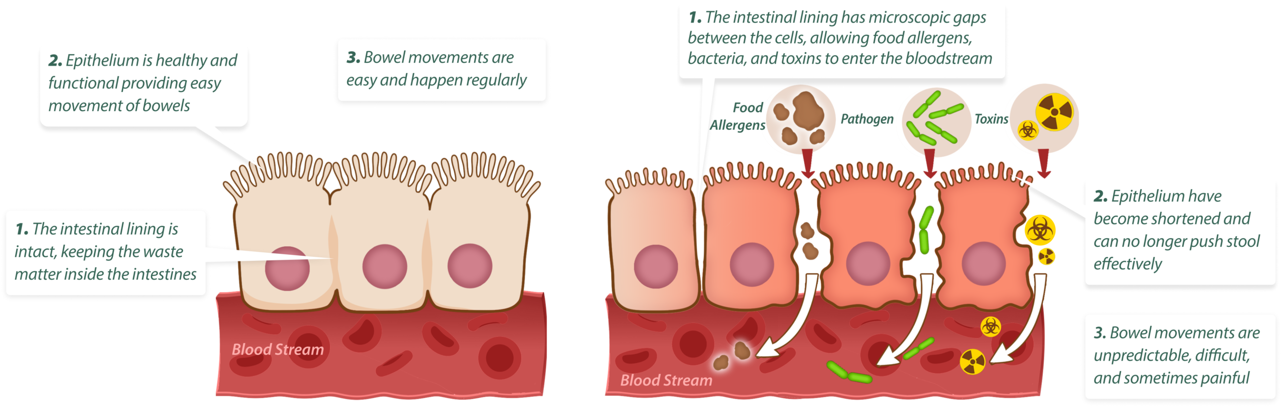 Comparison of a healthy intestinal lining and leaky gut